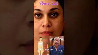 Stem Cell Facial Rejuvenation #stemcell #facialstemcell #fatgrafting