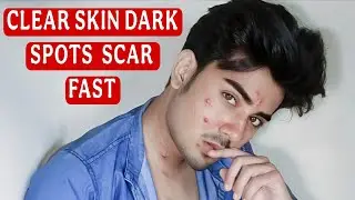 How to Remove Dark Spots & Scars | Causes, Treatment & Skincare Tips