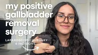 Gallstone Got Stuck in My Gallbladder | Emergency Surgery | 1 week post op recovery update