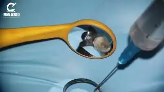 Root canal preparation