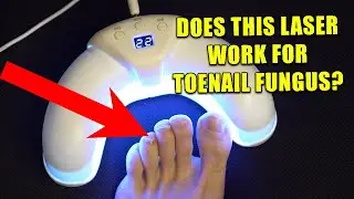 Neoclear Laser For Toenail Fungus Review - I Tried Antifungal Device To See If It Actually Works!