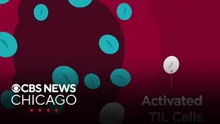 UChicago Medicine first in Midwest to offer TIL cancer treatment