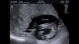 Echo Baby 13 Weken Zwanger Geslachtsbepaling Meisjes Foto's