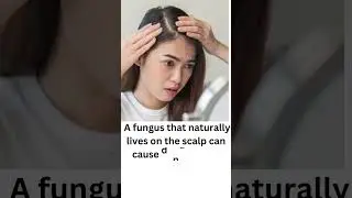 Causes of dandruff #video #viralvideo #viralshorts #viralreels #reels #facts #fact #trending #trend