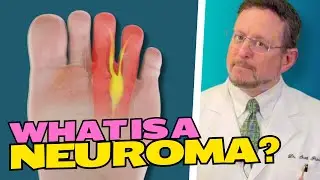 What is a Neuroma?