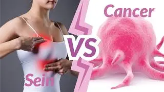 Essentielles en Oncogériatrie : Cancer du sein
