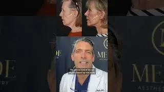 Looking At The Composite Facelift with Dr. Meade