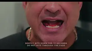 NAP 6DS Low Profile Mouthpiece Fitting Video
