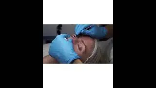 Hydrafacial ansiktsbehandling iSverige Stockholm