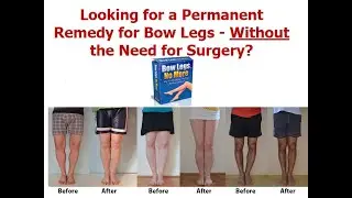 bow legs no more exercise 2020