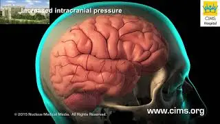 Craniotomy and Craniectomy (Hindi) - CIMS Hospital