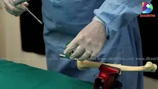 HUMERUS MULTILOCK NAIL Surgical Procedure Demonstration by DKSORTHO