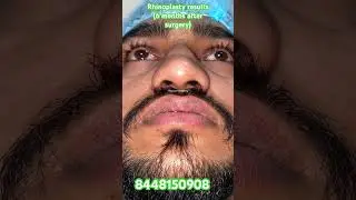 Chirurgia plastyczna nosa Delhi NCR. #rynoplastyka #operacjenosa #specjalistarynoplastyki #nos #Delhi
