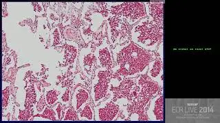 Chest - Patterns in chest radiology   Are there subtype patterns of ground glass opacity GGO