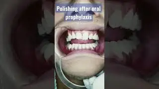 Detartrine polishing paste.# oral prophylaxis paste #healthyteeth