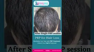 Reclaim your hair's natural vitality and radiance with our transformative PRP treatment. #skincare