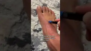 Foot Recovery Update?