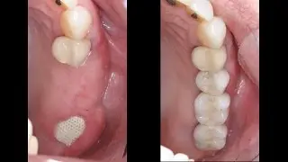 Missing Teeth-  Dental Implant Supported Bridge