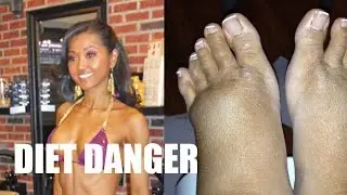 Extreme Diet / Rare Case - BACKSTORY Mimi Bonny Part 2