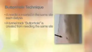 Preparing for Dialysis - Chapter 9: Preparing for fistula creation