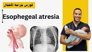Pediatric surgery | Esophageal atresia