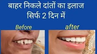 Treatment of protruding teeth in just 2 days/Smile design treatment/UP to Jaipur smile transforma...