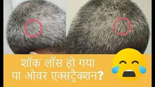 What is Shock Loss | Shock Loss in my case | Over Extraction in Hair Transplant | KV Hair Care