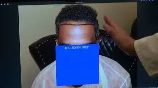 Art of African Curly Hair Transplant | 1-Year FUE Results with Natural Hairline