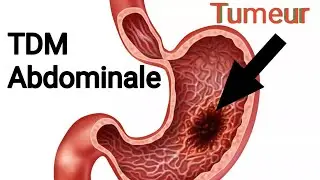 TDM ABDOMINALE  DOULEUR ABDOMINALEEPYGASTRALGIE (55 ans ) Processus l&eacute;sionnel pari&eacute;tal gastrique
