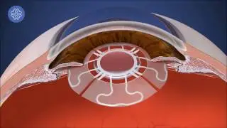 How AD-IOLs work
