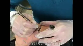Microblandig kil tekniği
