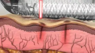 Clear + Brilliant How it Works Video