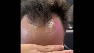 D&igrave; addio al denaro e alla stempiatura，Ottieni un'attaccatura perfetta！#capelli  #hairloss