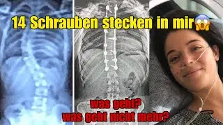 Was nach meiner Skoliose OP möglich ist – und was nicht😱💪🏽