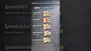 Spine conditions #orthopedics #backpain #physiotherapy #physiotherapist #spine #spinehealth #oldage