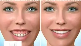 Impactaci&oacute;n Maxilar (Sonrisa Gingival) Cirug&iacute;a Ortogn&aacute;tica