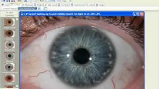 Constitutional Iridology in IS51