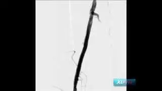 Mid SFA In-Stent Restenosis Treated with Angiosculpt and Viance
