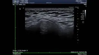 Asvide: Measurement of the near medial knee joint space width (JSW2)