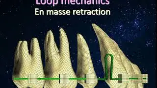 loop mechanics en masse retraction