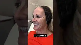 Sculptra: Restore Volume & Youth | Memorial Spa