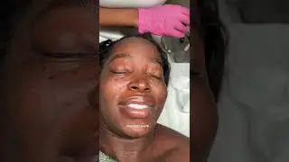 BURNING MY MOLES OFF 😱I got more DPN Moles AFTER PREGNANCY & THEY GOTTA GO🔥 #shorts #shortvideo