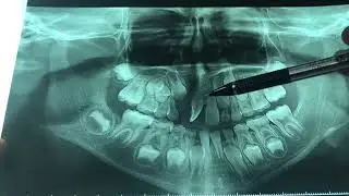 Placa Hawley con resorte “z” ganchos adams , plano de mordida posterior , arco vestíbular y pulido L