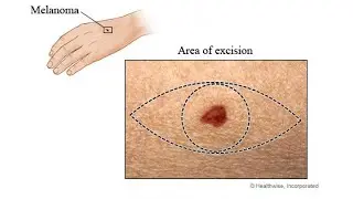 EXCISION OF LESION (diameter + margins)