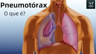 O que é um pneumotórax?