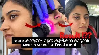 MNRF Treatment ചെയ്തു- എന്റെ Experience ഇതാണ് | 