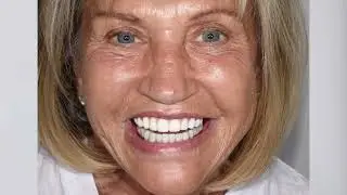 All on X Full Mouth Rehab