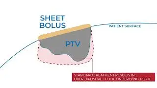 Adaptiiv's Modulated Electron Bolus