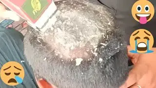 Asmr dandruff removel, dandruff kaise hataye, asmr haircut ! Feadon Asmr 