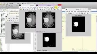 Brain Tumor Detection and Classification Using Matlab | Brain Tumor Prediction Analysis